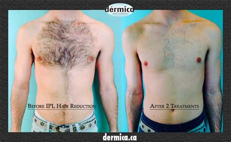 Lucere provides laser for hair removal treatment in edmonton that is safe and effective for all types of skin. Mens laser hair removal Edmonton (IPL Hair Reduction)