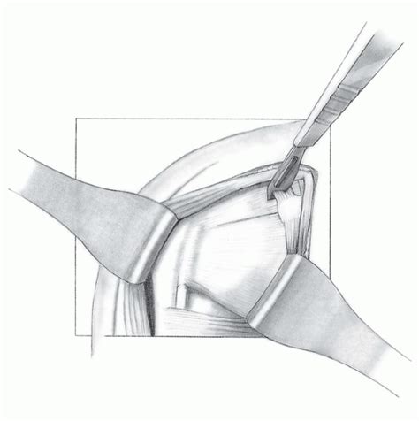 There are several important ligaments in the shoulder. Total Shoulder Replacement with Intact Bone and Soft ...