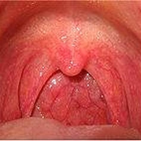 Sore throats can be painful and annoying. About Sore Throats | Healthy Living