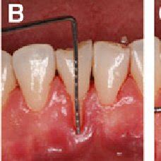 They can contain a political position on to set a coordinated position between the eu and its member states in international organisations. (PDF) Laser-Assisted Laterally Positioned Flap Operation ...