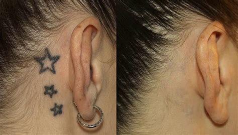 Most tattoo removal technicians use a standard method to estimate your treatment time. Tattoo Removal - Non Laser | Clear Choice Beauty, Warwick NY