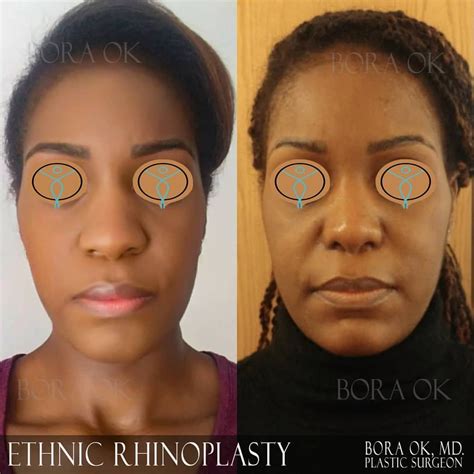 Subscribe rhinoplasty (nose job) newsletter to get updates in your mailbox. Pin on Ethnic Rhinoplasty (Nose Job)