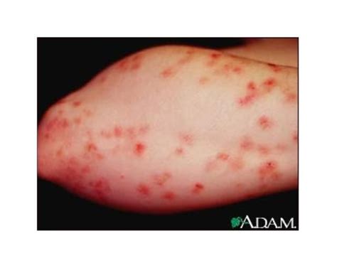 Maybe you would like to learn more about one of these? Does Your Gluten Rash Look Like These 5 Photos ...