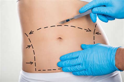 Many patients have other cosmetic surgeries performed at the same time as their bbl, which can prevent them from performing the. Tummy Tuck - Plastic Surgery - Dr. Karaca MD - Bloomfield ...