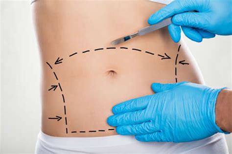 Recovery after two major procedures tends to be much more difficult and uncomfortable. Tummy Tuck - Plastic Surgery - Dr. Karaca MD - Bloomfield ...