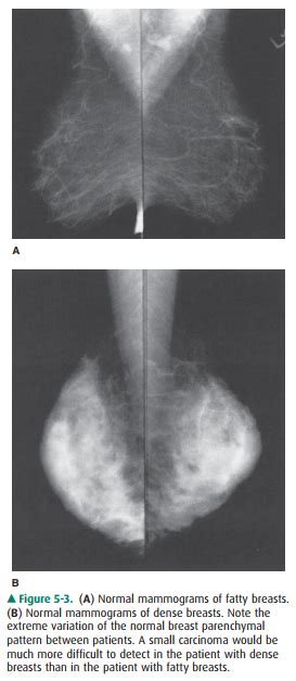 Anatomy of the breast kirby i. Radiology of the Breast: Technique and Normal Anatomy