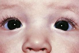 The skin folds at the inner corner of the eyelids are called epicanthal folds and can be broad in some babies. Ophthalmology | Obgyn Key