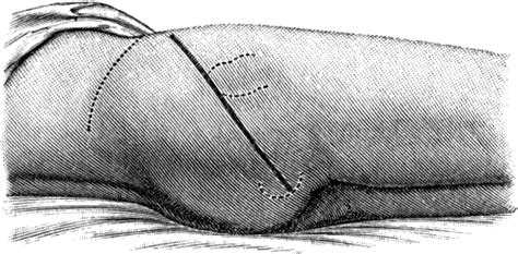 The treatise of the human anatomy and its applications to the practice of medicine and surgery, volume iii' (1903). The Project Gutenberg eBook of Manual of Surgery Volume 2 ...