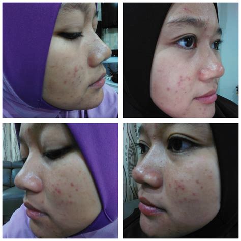 Lol finally dragged myself to the ting's skin clinic at jalan imbi. kisah hidupku...: Review selepas rawatan ko skin specialist