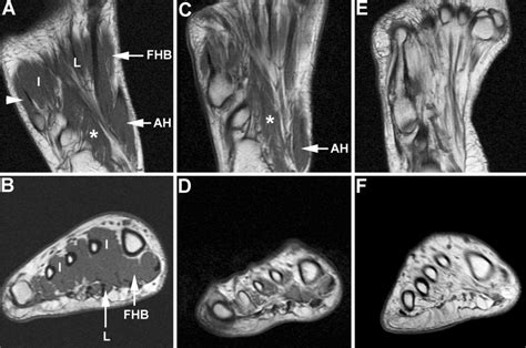 Muscle was closely related to the volume of all foot muscles determined by mri as described above. МРТ стопы - Виды МРТ