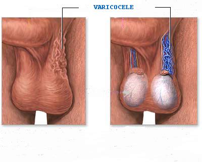 This leaflet will explain what a varicocele embolization is and why you have been sent for one. Il Varicocele - Dott. A. Giambersio