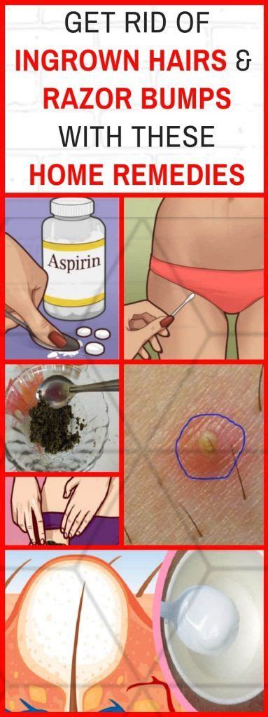 This skin care tool helps remove ingrown hair and repair razor bumps. Get Rid Of Ingrown Hairs And Razor Bumps With These Home ...