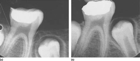 The pulpotomy procedure involves removing pulp tissue that has inflammatory or degenerative changes, leaving intact the remaining clinically appearing healthy tissue, which is then covered with a. 17: Pulp Therapy of Immature Permanent Teeth | Pocket ...