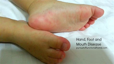 Signs and symptoms of hfmd. My kids had Hand, Foot and Mouth Disease (HFMD) - Pursuit ...