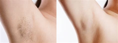 Armpit hair removal by laser is the most painless and permanent way. Splendor X Hair Removal - Bella Visage Medical ...