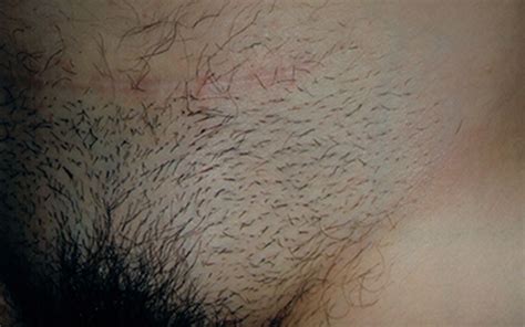 Laser hair removal helps remove unwanted hair without damaging the skin. Before and After Hair Removal Results - CLHR