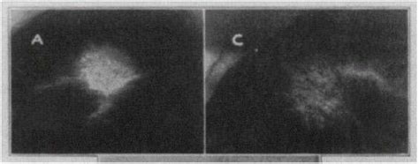 Effects of tocotrienol supplementation on hair growth in human volunteers. Before and after vitamin A hair growth