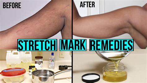 As the name implies, stretch marks are caused by rapid weight gain, causing the elastic fibers of our skin to snap and break, resulting in red, pink, brown, white, or gray scars. HOW TO GET RID OF STRETCH MARKS & SCARS + DIY AT HOME ...