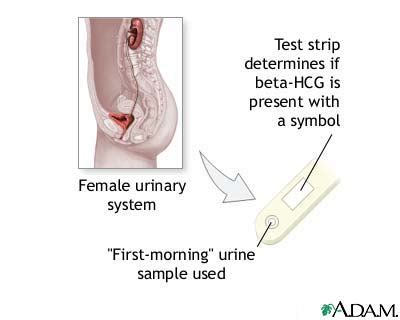 Blood pregnancy test (beta hcg). Pregnancy test: MedlinePlus Medical Encyclopedia Image