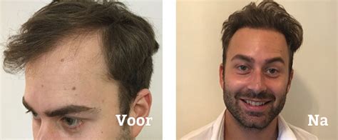 Welke andere bekende nederlanders ondergingen haartransplantatie? Haartransplantatie behandeling? Kosten, ervaringen, foto's ...