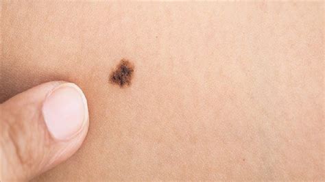 Cutting off the mole with scissors. how to get rid of birthmarks fast at home - YouTube