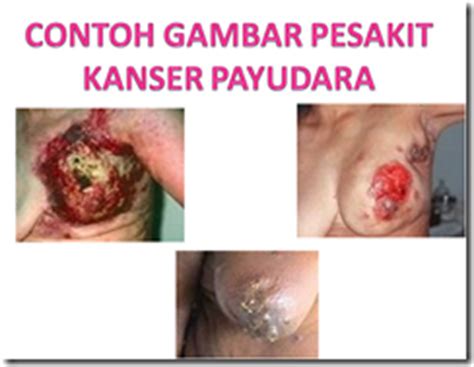 Tips yang paling inti dan wajib adalah, lakukan kebiasaan sehat. KOLEKSI TUGASAN: TEKNIK DIAGNOSIS KANSER PAYUDARA JENIS ...