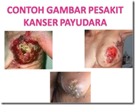 Boleh berlaku apabila sel normal payudara bertukar struktur dan merebak. KOLEKSI TUGASAN: TEKNIK DIAGNOSIS KANSER PAYUDARA JENIS ...