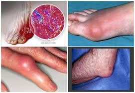 Jika anda mempunyai kebimbangan mengenai gejala tertentu, sila berjumpa dengan doktor anda. Masalah Penyakit Gout dan Buah Pinggang - Product Report
