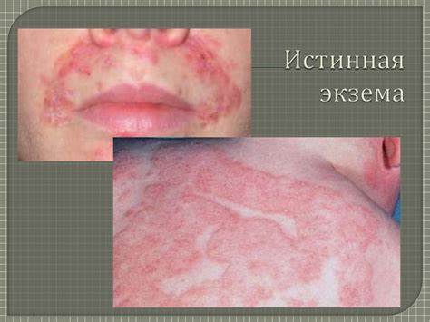 Экзема истинная диета Экзема (eczema; греч. ekzema высыпание на коже) - презентация онлайн Экзема (eczema; греч. ekzema высыпание на коже) - презентация онлайн Экзема истинная диета