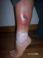 Avoid the stress of doing it yourself. Mold Health Effects | Safe Mold Solutions : Chapter 5