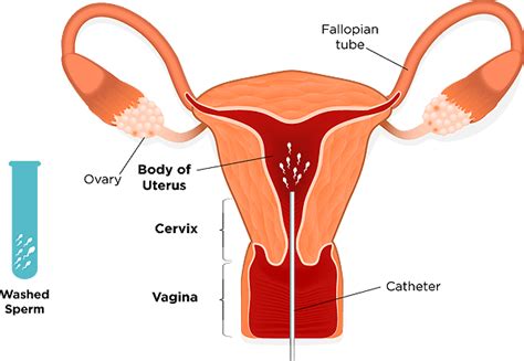 The sperms are inserted with the help of a fine. IUI - Intrauterine Insemination Treatment Centre | Embryo ...