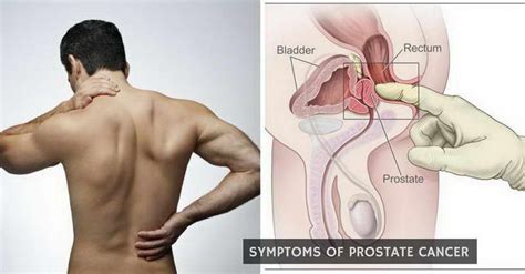 Your bladder and bowels can be a good indicator of uterine problems, and that includes cancer. 12 Deadly Symptoms Of Prostate Cancer That Must Not Be ...