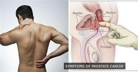 These signs may include blood in the urine, pain on urination, increased frequency of urination, and in more advanced cases, obstruction of the urethra leading to a Deadly Symptoms Of Prostate Cancer That Must Not Be Neglected