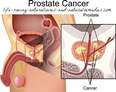 This is cancer that has spread, or metastasized, to the lymph nodes or other parts of the body. Natural Cures for Prostate Cancer That Get Powerful Results!