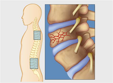 Osteoporosis | Compression fracture | Vertebroplasty ...