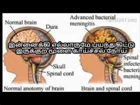 But if you thought you knew everything about the process, think again. brain fever solution in tamil - YouTube