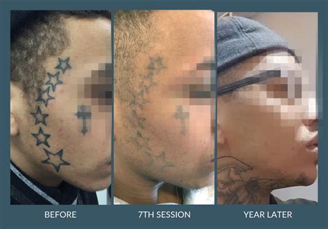 The tattooed skin is cut out and the scars are the most common side effect of tattoo removal. Laser Tattoo Removal in Leicester - G-Lasers