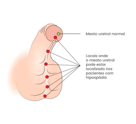 Cada semana por 3 semanas. Urologia Pediátrica e Hipospádia | ACLS Onofre