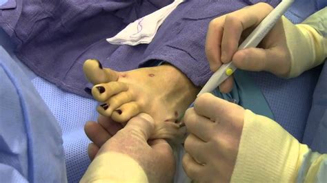 By the time it becomes severe if your bunion is not severe, your doctor may advise that surgery is not necessary. Watch Dr. Sherman Nagler perform a Taylor's Bunionectomy ...