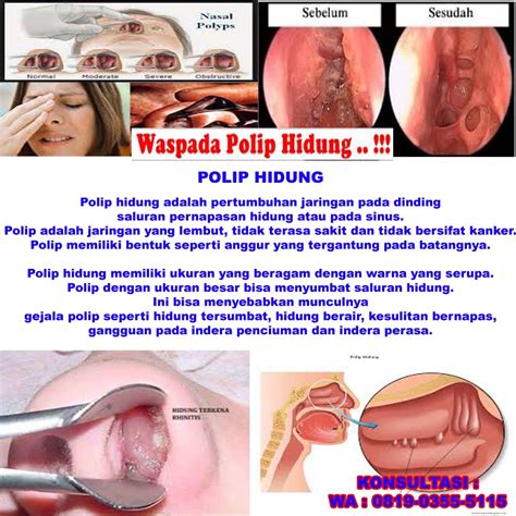 Maybe you would like to learn more about one of these? Nama OBAT POLIP HIDUNG SECARA ALAMI TANPA OPERASI BISA SEMBUH