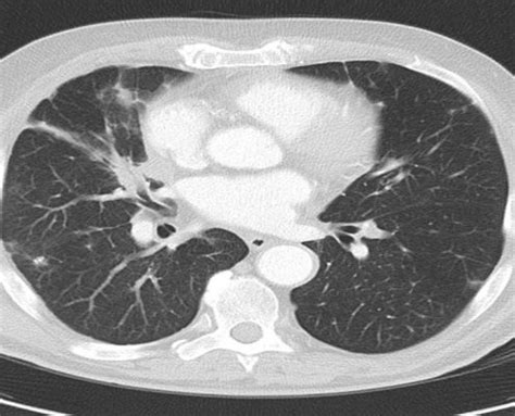 Un scanner est réalisé dans tout centre de radiologie ou service de radiologie équipé, ce qui est le cas de plus en plus de centres en france. Explorations thorax : scanner, fibroscopie, endoscopie Hôp ...