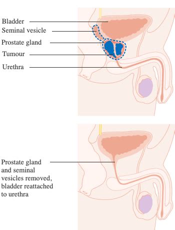 The radiation exposure can cause other cancers. Sexual Dysfunction After Prostate Cancer - Physiopedia