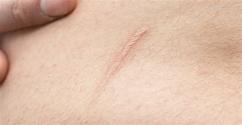 This type of treatment can cause the skin to be very sensitive and. Scar Reduction Springfield | Acne Scar Removal Springfield