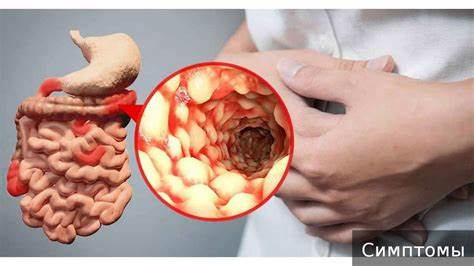 Болезнь Крона. Как лечить болезнь Крона. - YouTube Картинка - Болезнь Крона. Как лечить болезнь Крона. - YouTube