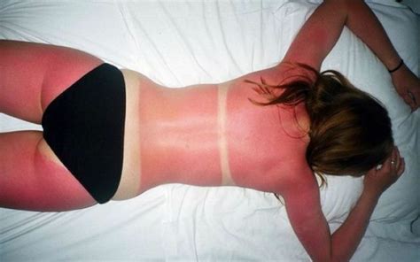 Les coups de soleil sont associés au mélanome, la forme de cancer de la peau la plus dangereuse. Morning Picdump (57 pics) - Izismile.com