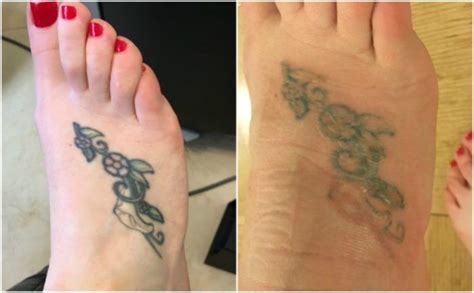 As alluded to earlier, the tattoo removal industry makes billions in profit every year. Experience with Picosure Laser Tattoo Removal NYC (With images) | Laser tattoo, Laser tattoo ...