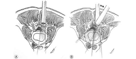 International scientific vocabulary, from latin ipse self, himself + later. (A) Ipsilateral laminectomy is performed by burring ...