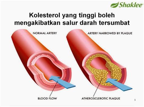 Penularan wabak penyakit dikaitkan sebagai merebaknya sesuatu penyakit dalam kalangan masyarakat sehingga menimbulkan kegawatan yang melampau. Kolestrol Punca Penyakit Jantung | suarahati