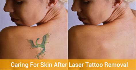 Maybe you would like to learn more about one of these? Skin Care After Laser Tattoo Removal | Fairview Laser ...