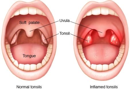 Kenari diberi pakan buah dan sayur. 9 Cara Efektif Merawat Tonsil Bengkak Pada Bayi & Kanak-kanak